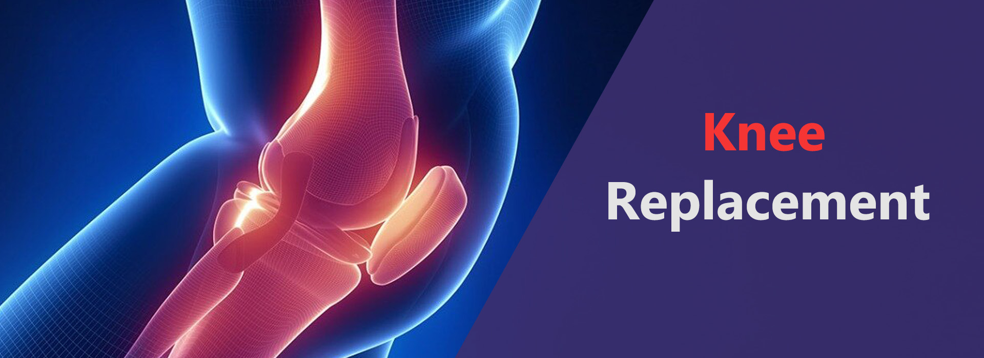 best knee replacement surgeon in Delhi